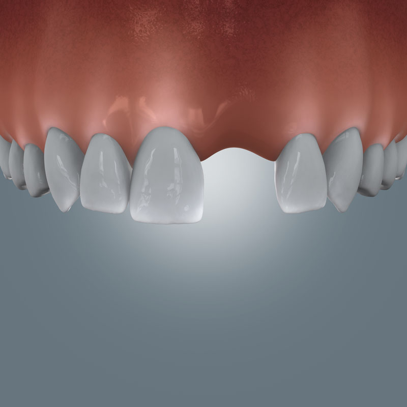 Darstellung einer fehlenden Frontzahnposition als Einzelzahnlücke im Oberkiefer