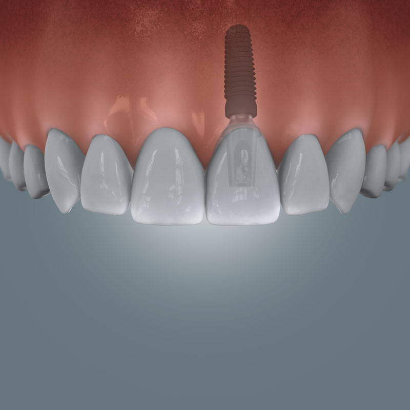 Grafische Darstellung einer Implantatversorgung bei einer Einzelzahnlücke im Frontzahnbereich