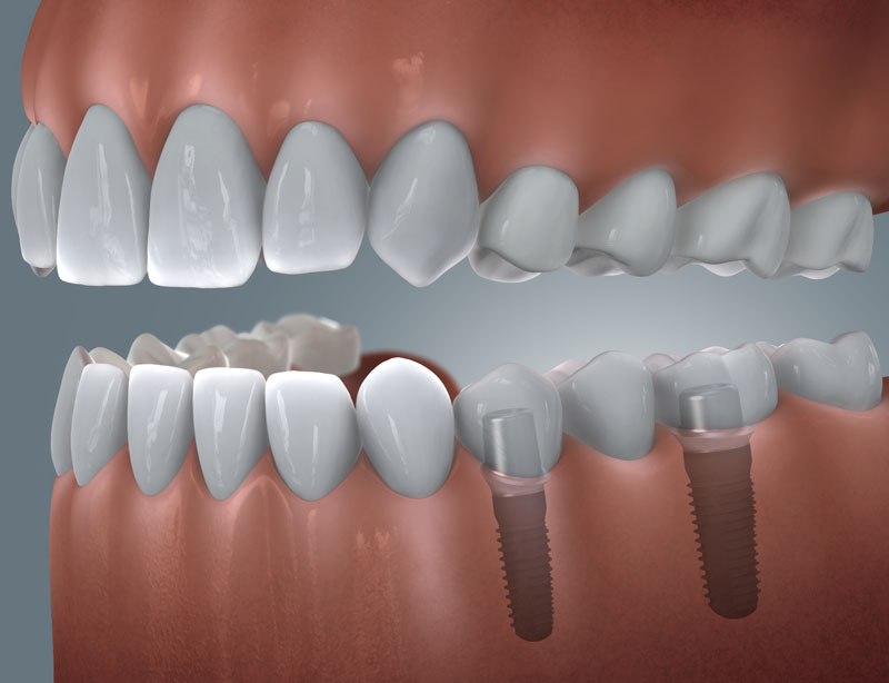 Grafische Darstellung einer Schaltlücke im Unterkiefer, versorgt mit zwei Implantaten und Kronen