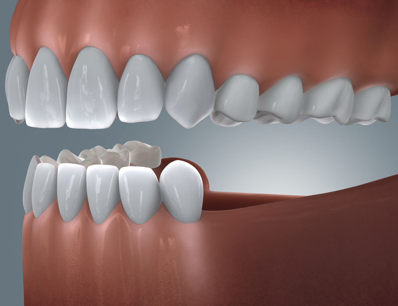Grafische Darstellung einer Freiendlücke im Unterkiefer mit fehlenden Backenzähnen am Zahnreihenende