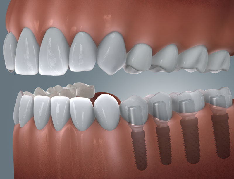 Grafische Darstellung einer Freiendlücke im seitlichen Unterkiefer, die mit mehreren Implantaten und Kronen versorgt ist