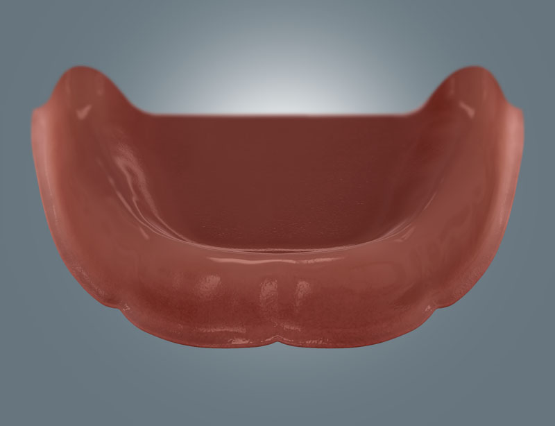 Grafische Darstellung eines zahnlosen Unterkiefers als Ausgangssituation für eine Implantatversorgung