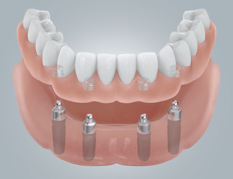 Grafische Darstellung eines zahnlosen Unterkiefers mit vier Implantaten und Kugelankern als Halteelemente für eine herausnehmbare Prothese