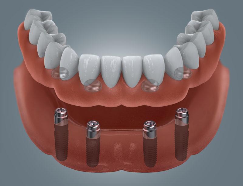 Grafische Darstellung eines zahnlosen Unterkiefers mit vier Implantaten und Locator-Aufsätzen als Halteelemente für eine herausnehmbare Prothese