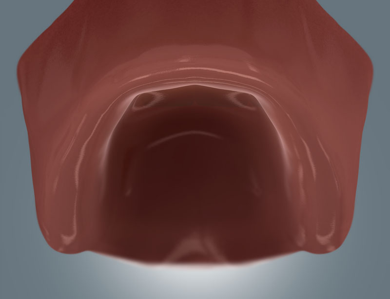 Grafische Darstellung eines zahnlosen Oberkiefers, Ausgangssituation vor einer Implantat- oder Prothetikversorgung