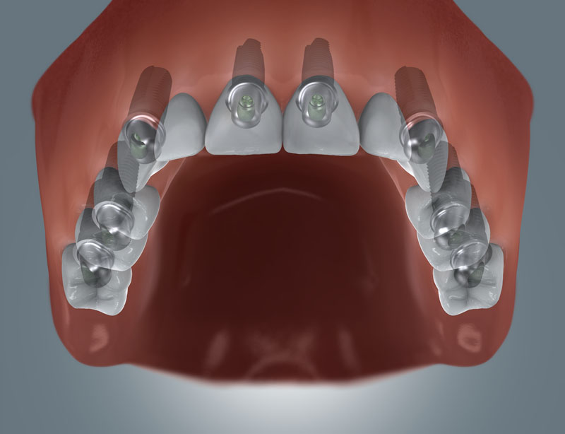 Grafische Darstellung eines zahnlosen Oberkiefers mit Implantaten, die Aufbauten tragen und mit einer Brücke versorgt sind