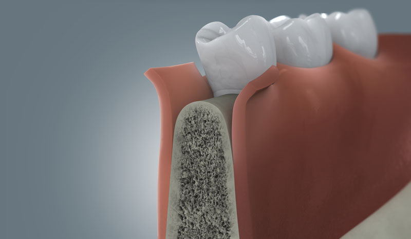 Illustration des freigelegten Kieferknochens vor der Implantatbettaufbereitung
