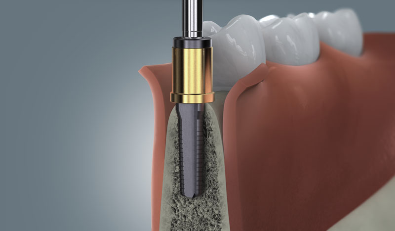 Illustration der Implantatbettaufbereitung im Kieferknochen mit chirurgischem Bohrer