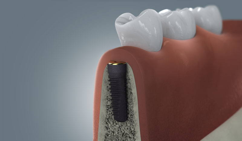 Illustration eines eingesetzten Zahnimplantats mit geschlossenem Zahnfleisch für die Einheilungsphase