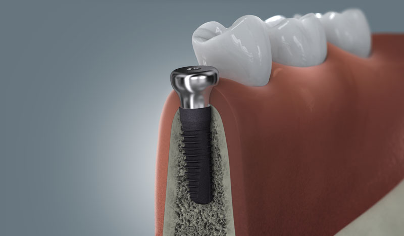 Darstellung eines Zahnimplantats im Schnitt: Implantatkörper im Kiefer, Aufbauelement (Abutment) oberhalb des Zahnfleischs