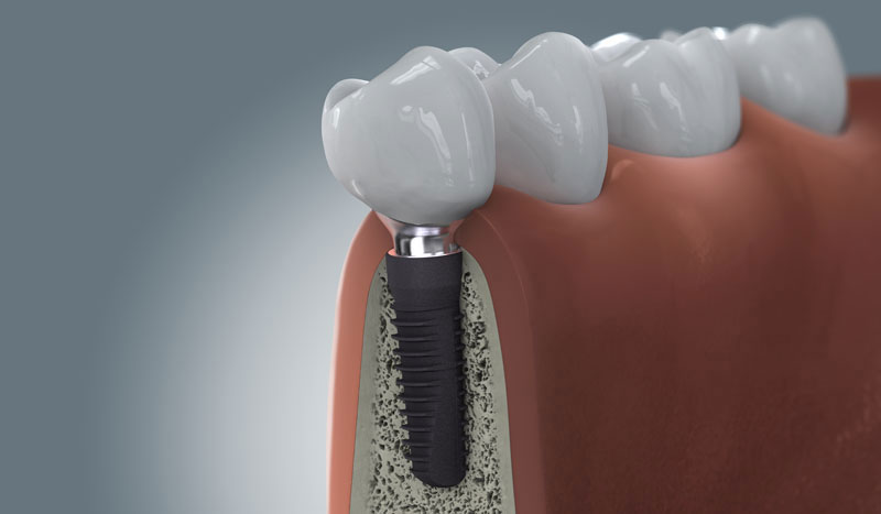 Darstellung eines Zahnimplantats im Schnitt: Implantatkörper im Kieferknochen mit aufgesetzter Zahnkrone