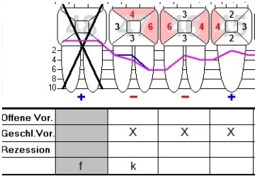 Ausschnitt eines Parodontalstatus mit markierten Taschentiefen, Rezesssionen und Einträgen zu offener und geschlossener Vorgehensweise.