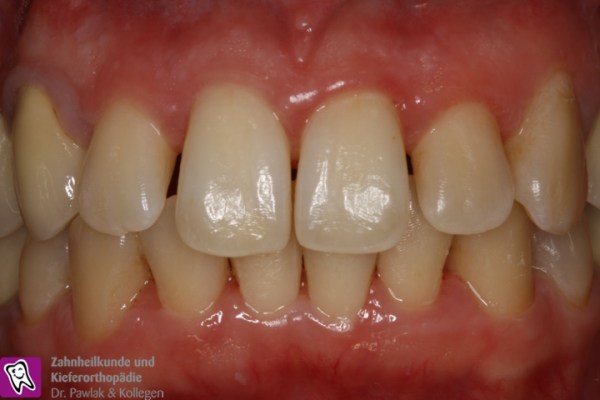 Frontzahnbereich nach Parodontitis-Behandlung mit gesundem Zahnfleisch.