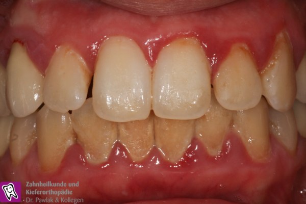 Frontzahnbereich vor Parodontitis-Behandlung mit entzündetem Zahnfleisch.