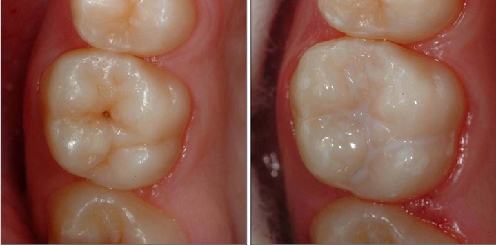 Vorher-Nachher-Bild einer Fissurenversiegelung: Links tiefe Rillen in den Backenzähnen, rechts versiegelte und glatte Kauflächen.