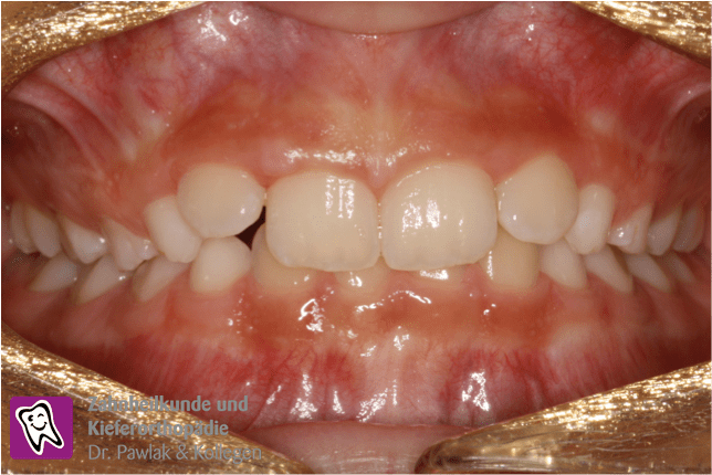 Oberkiefer nach der Frühbehandlung bei einem frontalen Kreuzbiss