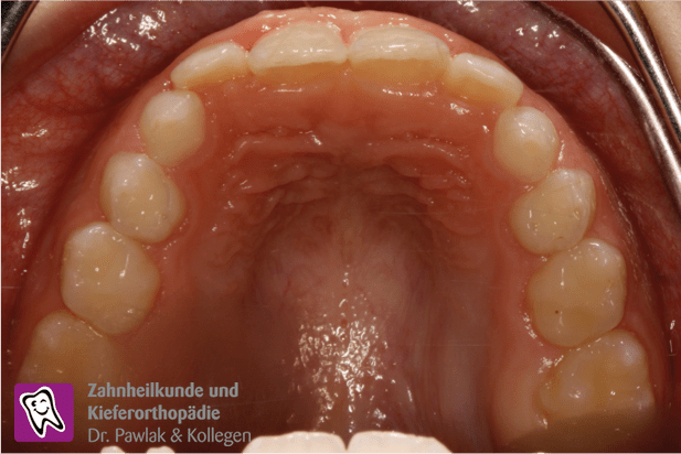 Oberkiefer nach der Frühbehandlung bei einem frontalen Kreuzbiss