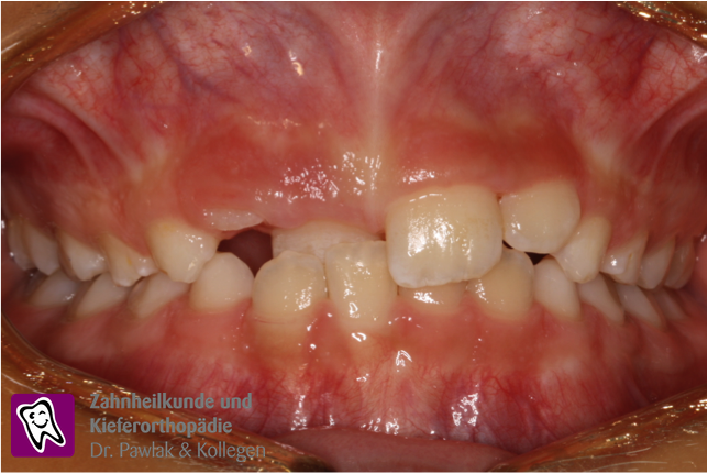 Oberkiefer vor der Frühbehandlung bei einem frontalen Kreuzbiss